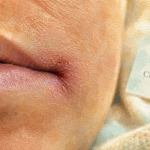 Commissure des levres fendues, perlèche ou mycose : coin de bouche gercé